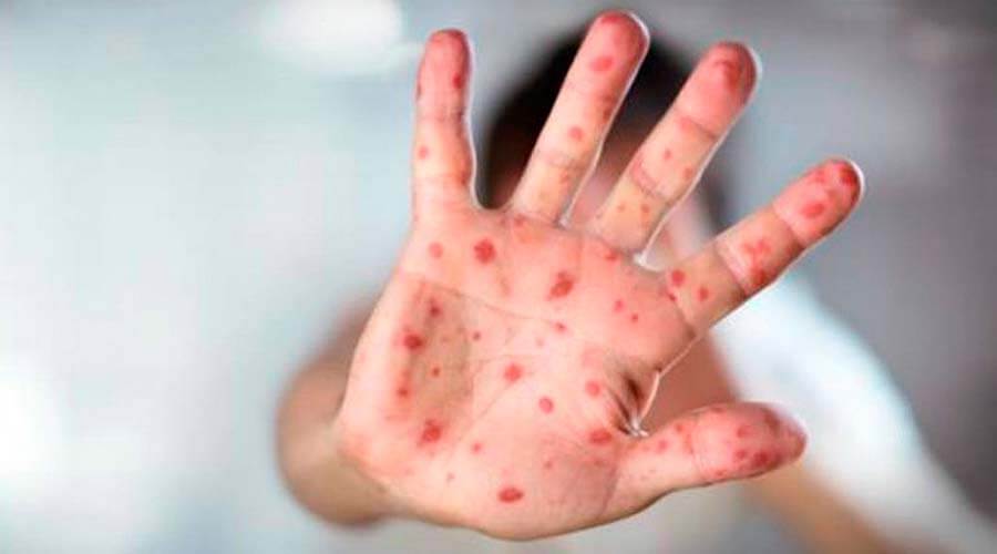 En Colombia reportan segundo caso de sarampión importado de Venezuela